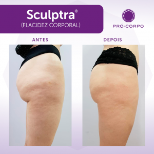 Sculptra Antes e Depois